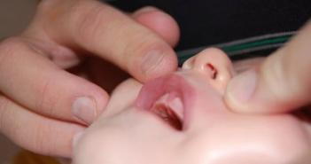 Молочница на языке у новорожденных